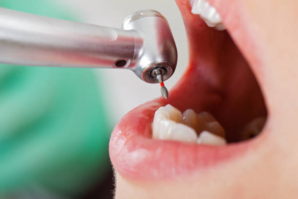 Best Knocked-Out Tooth (Avulsed Tooth) Treatment in Ashwaubenon, WI